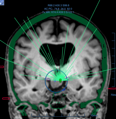 CT image of an epileptic patient